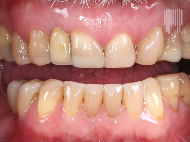 Anterior View Crown_After
