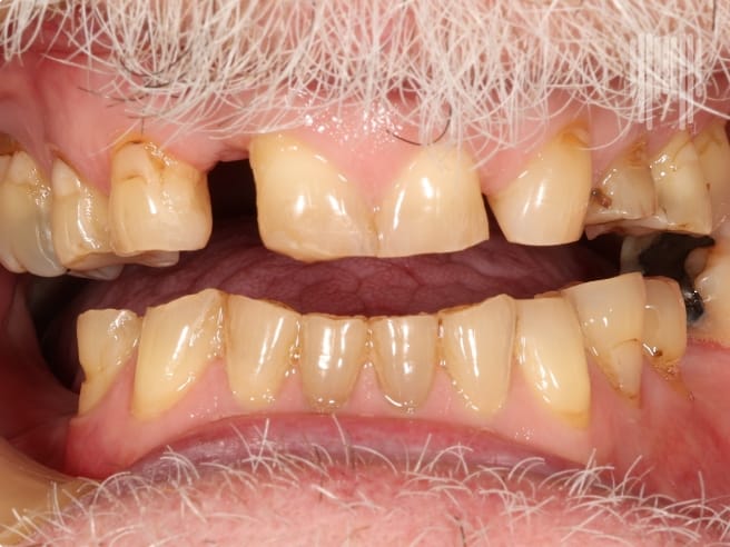 Anterior View Crown_Before