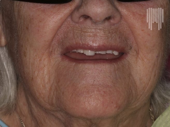 Dentures_Before