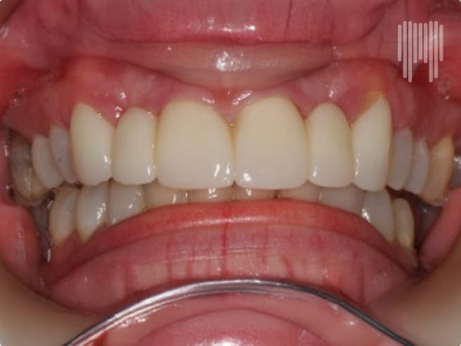 Orthondontics & Veneers_After