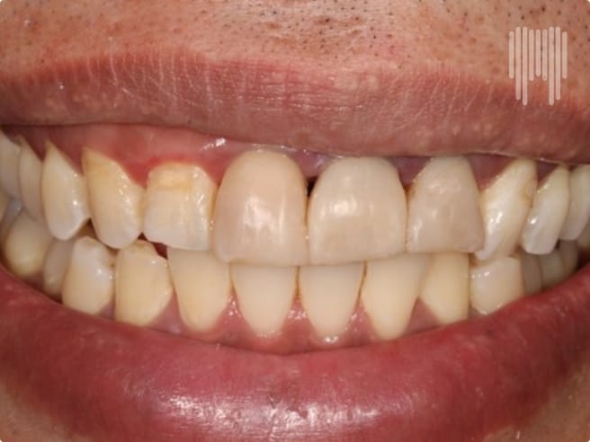 Composite Veneers_After