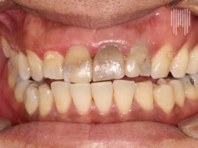 Composite Veneers_Before